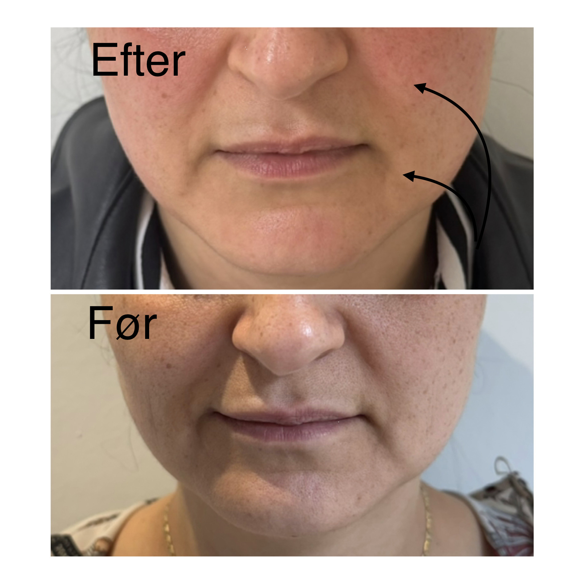 Ems F├©R Efter 3 Elegance Beauty Odense