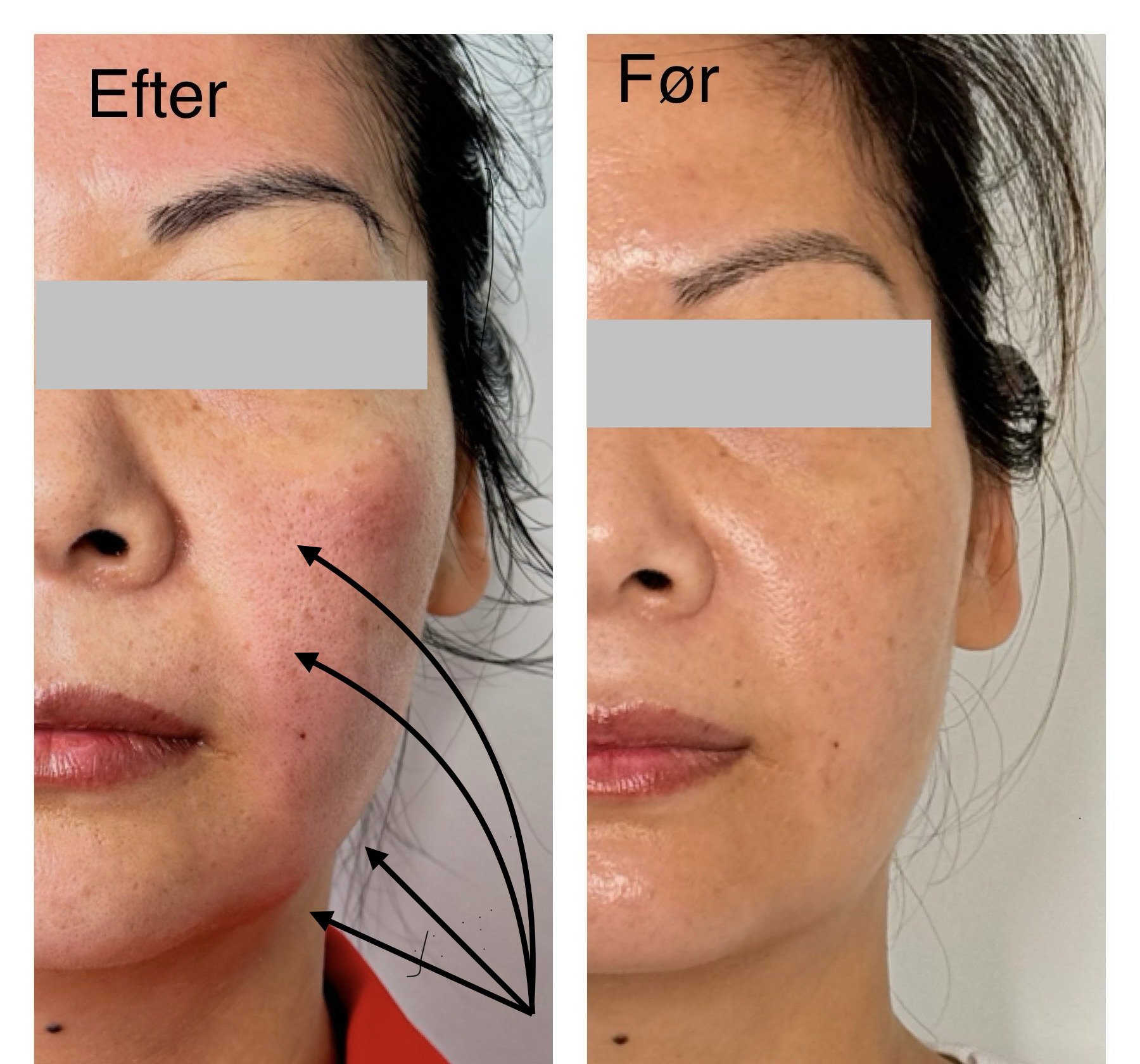 Ems F├©R Efter Hos Elegance Beauty