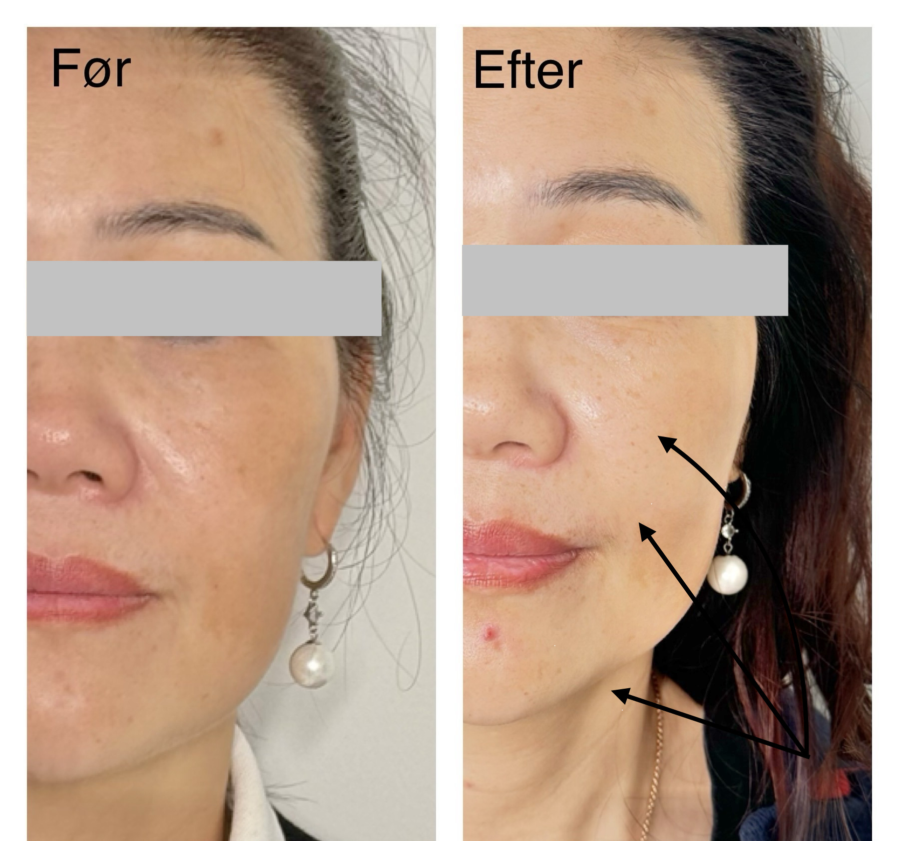 Ems Face F├©R Efter 1 Elegance Beauty Odense